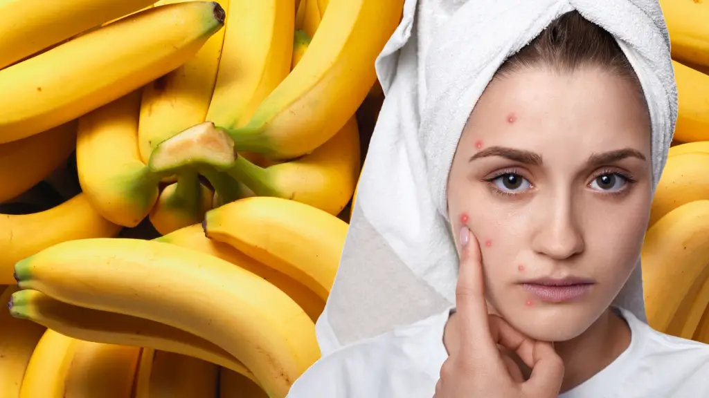Debunking the Myth of Bananas Causing Acne