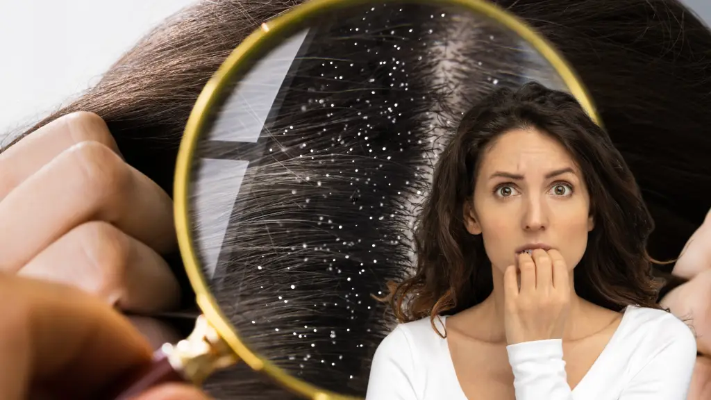 foods-that-cause-dandruff