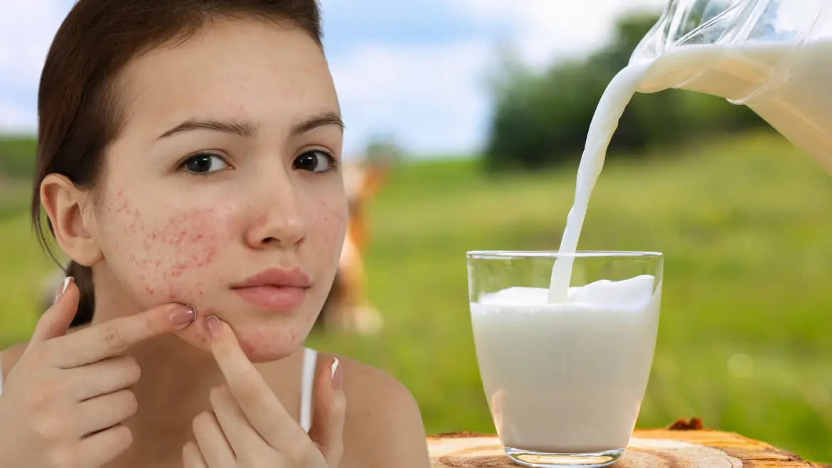 4 Milk Alternatives for Acne Improve Your Skin with These DairyFree